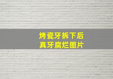 烤瓷牙拆下后 真牙腐烂图片